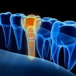 An illustration highlights a dental implant in an x-ray style graphic.