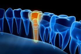 An illustration highlights a dental implant in an x-ray style graphic.