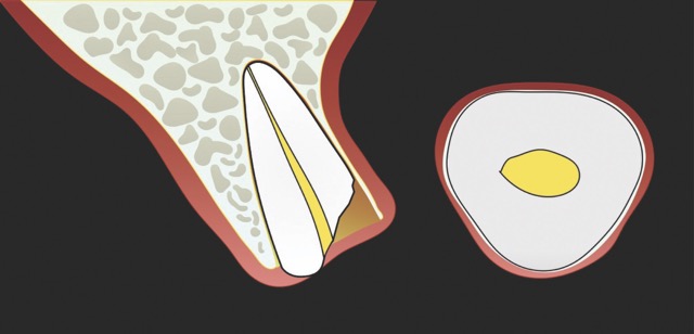 Illustration, Single-rooted tooth remnant with extensive coronal destruction and a subcrestal fracture