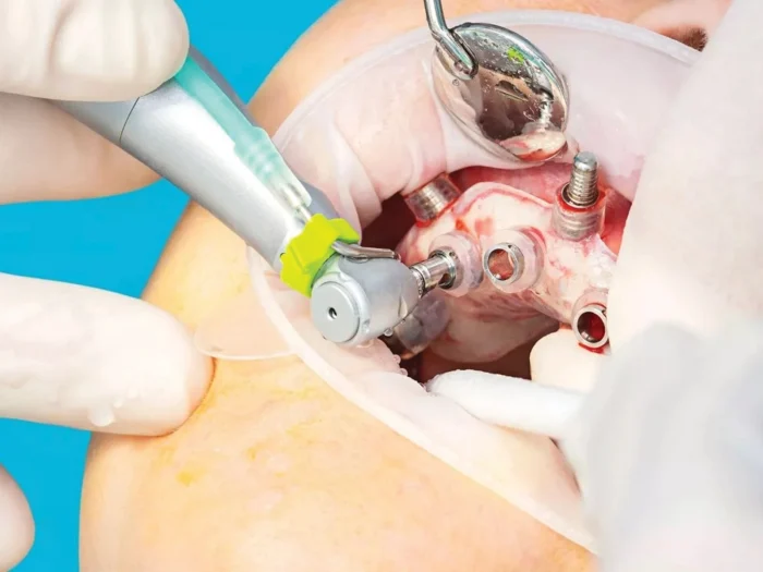 A guided implant surgery