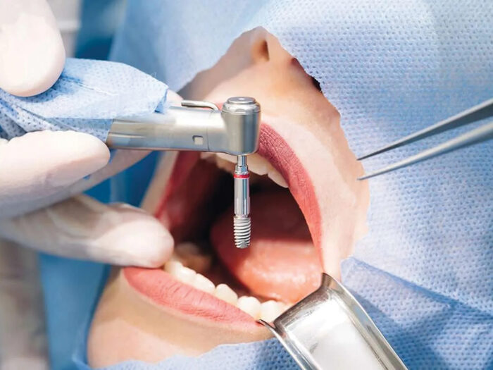 A traditional implant proceedure