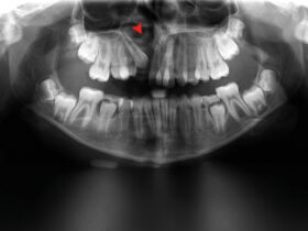 Panorex X-ray showing defect – red arrow – in the alveolus with maxillary canine tooth erupting into the cleft at age 13.