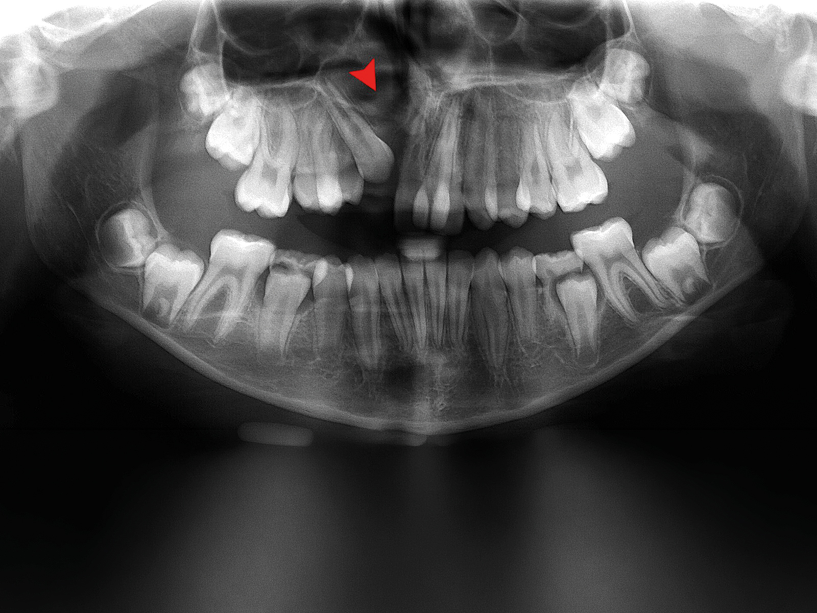 Panorex X-ray showing defect – red arrow – in the alveolus with maxillary canine tooth erupting into the cleft at age 13.